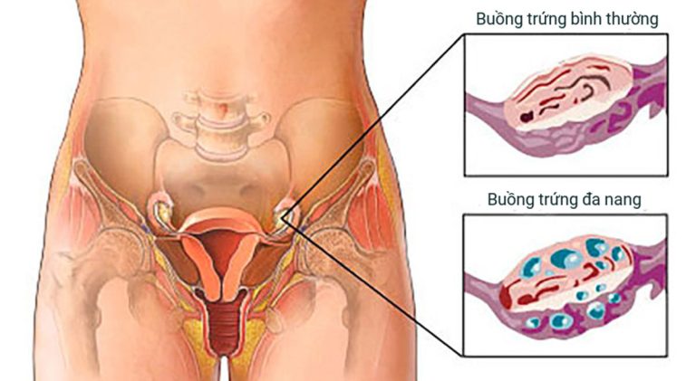 Buồng Trứng Đa Nang Là Gì?