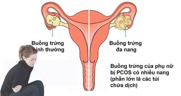 Buồng trứng đa nang (PCOS) là nguyên nhân thường gặp của tình trạng vô sinh hiếm muộn ở nữ giới