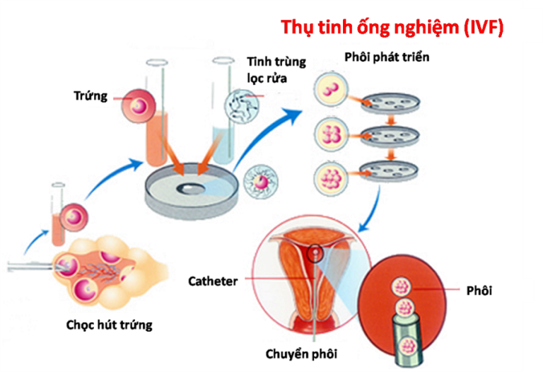 3 Lưu Ý Quan Trọng Trong Quy Trình Làm IVF Không Nên Bỏ Lỡ