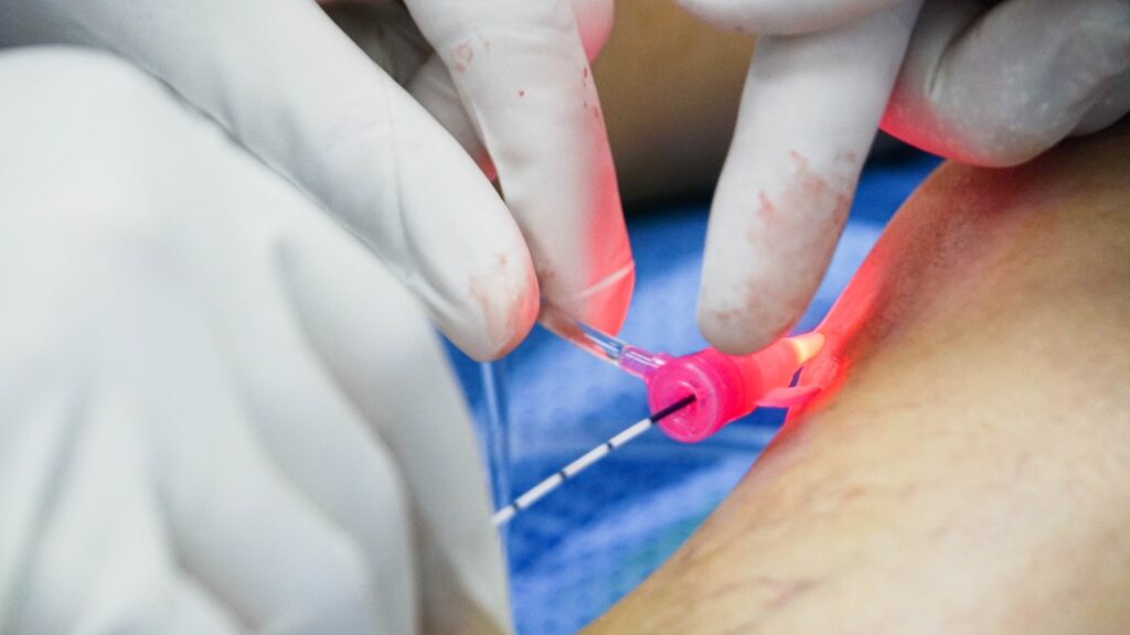 Tác Dụng Phụ Của Laser Nội Mạch