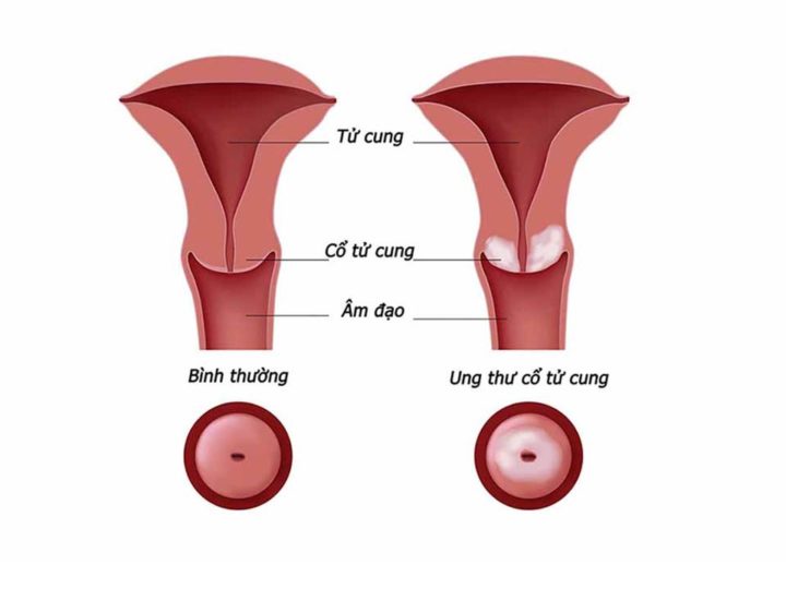 Đa nang buồng trứng có thể gây ra ung thư nội mạc tử cung